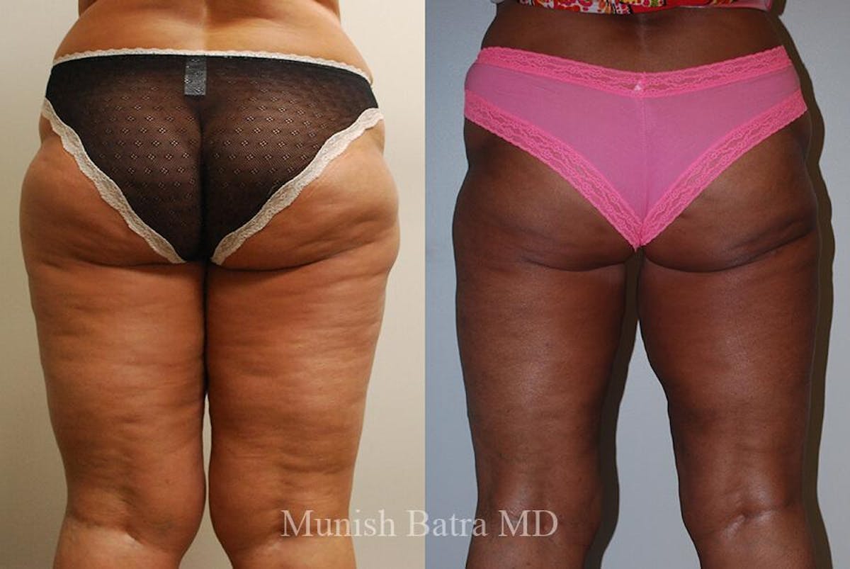 Liposuction & Body Contouring Before & After Gallery - Patient 209449 - Image 1