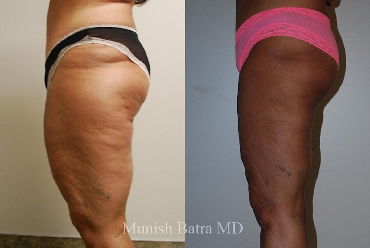 Liposuction & Body Contouring Before & After Gallery - Patient 209449 - Image 2