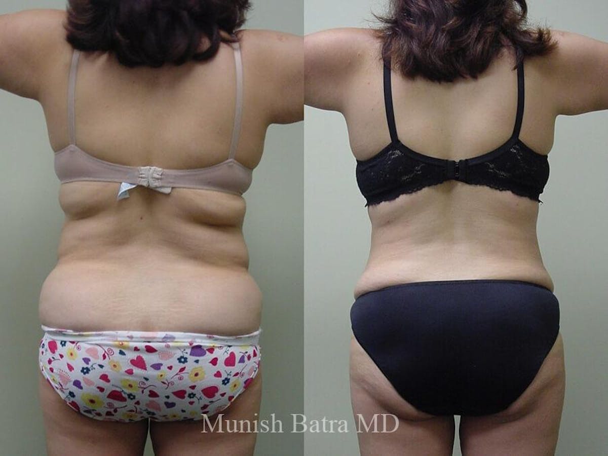 Liposuction & Body Contouring Before & After Gallery - Patient 108174 - Image 1