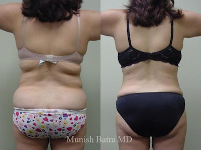 Liposuction & Body Contouring Before & After Gallery - Patient 108174 - Image 1