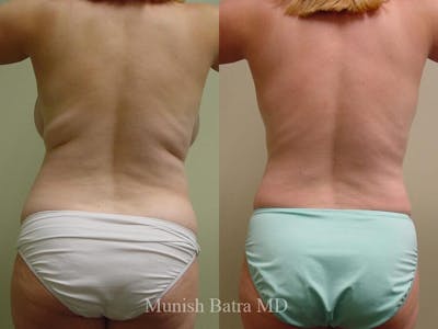 Liposuction & Body Contouring Before & After Gallery - Patient 576417 - Image 1