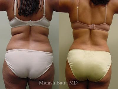 Liposuction & Body Contouring Before & After Gallery - Patient 762654 - Image 1
