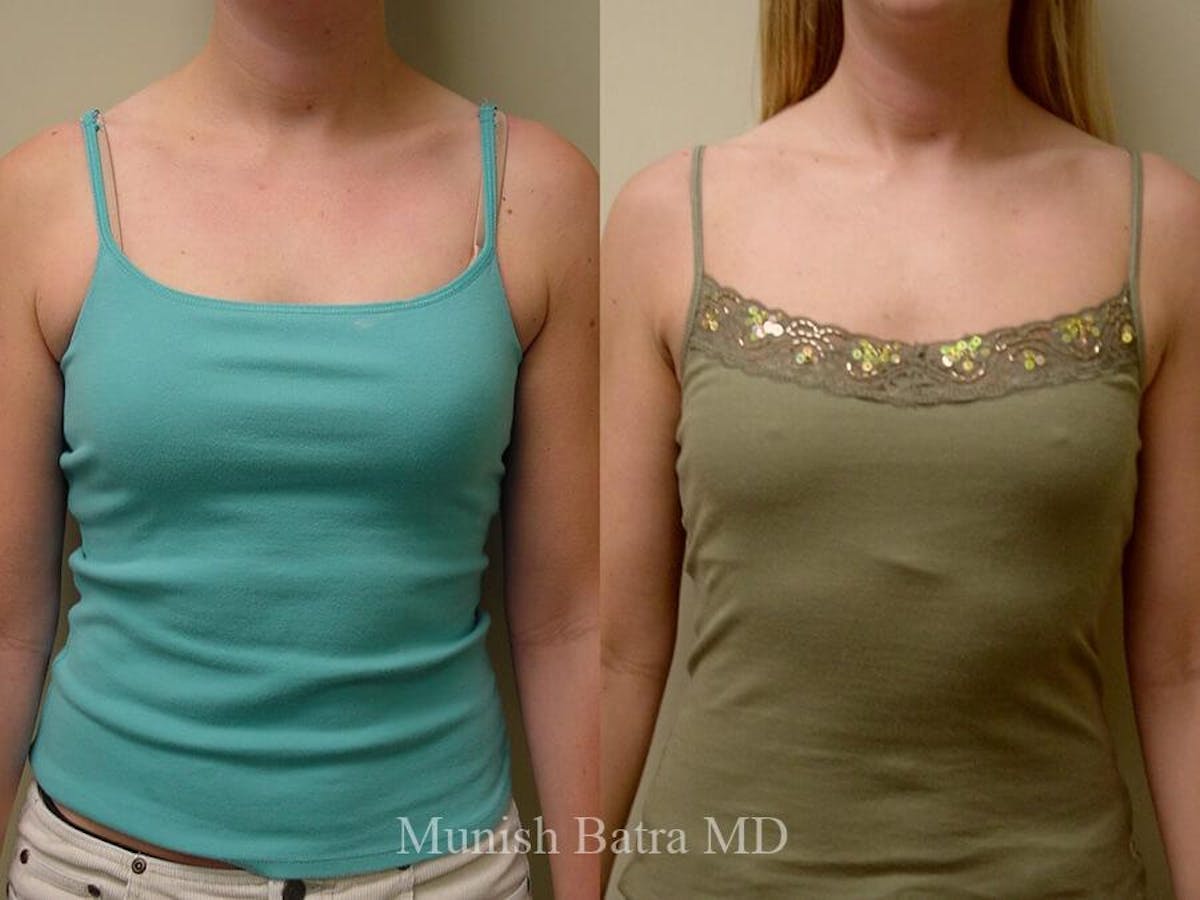 Liposuction & Body Contouring Before & After Gallery - Patient 231069 - Image 1