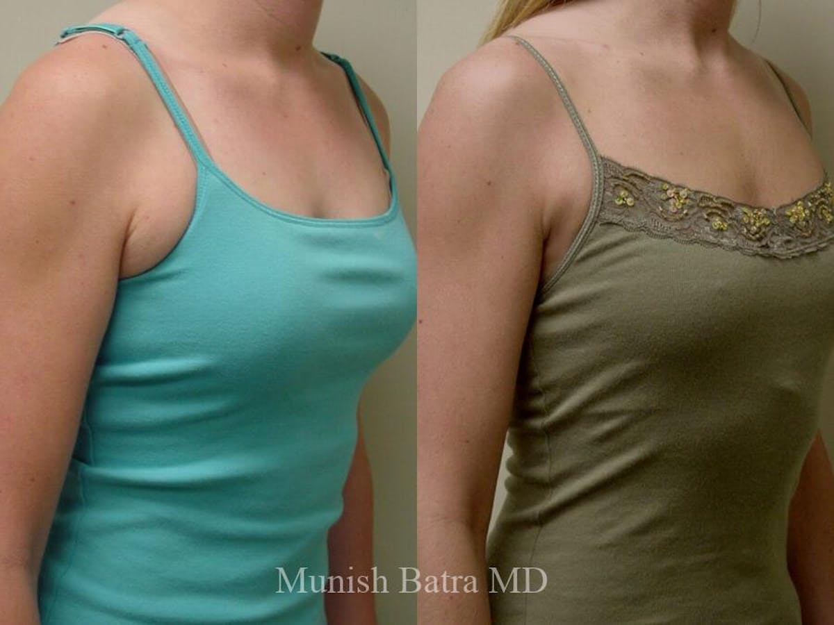 Liposuction & Body Contouring Before & After Gallery - Patient 231069 - Image 2