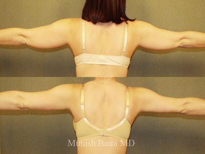 Liposuction & Body Contouring Before & After Gallery - Patient 386113 - Image 1