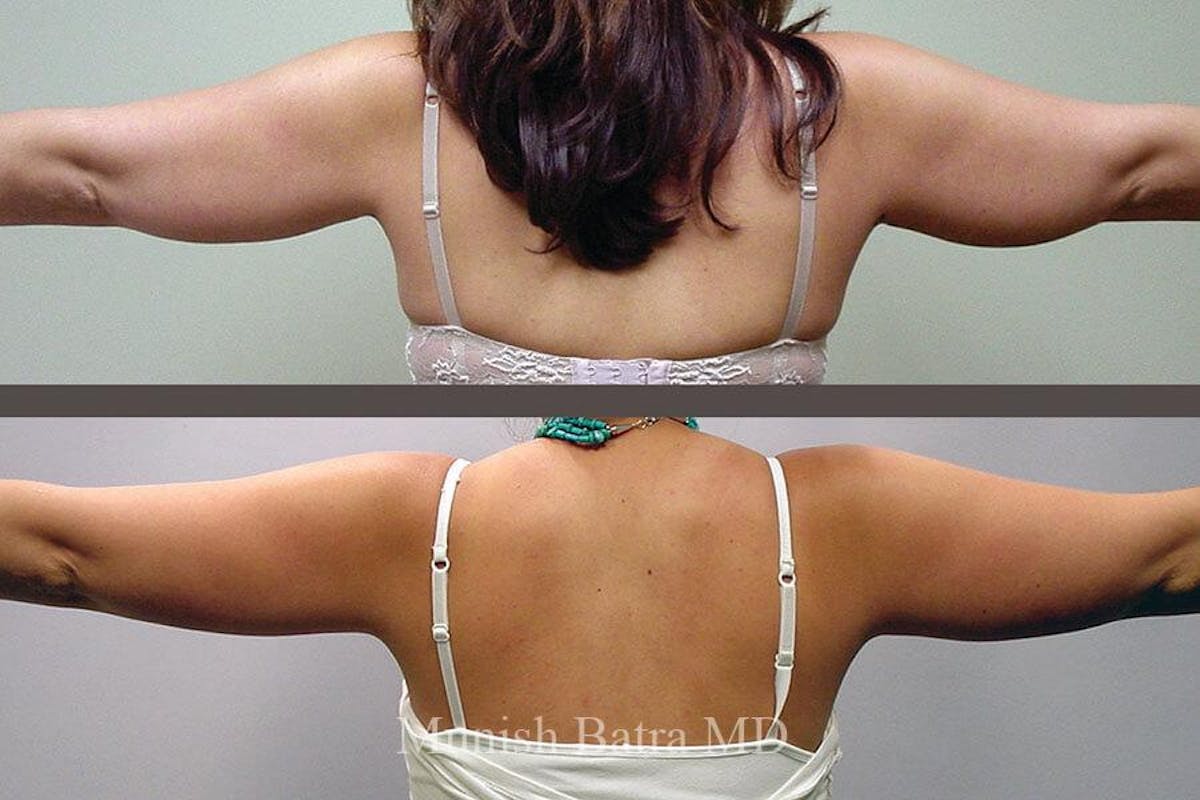 Liposuction & Body Contouring Before & After Gallery - Patient 300308 - Image 1