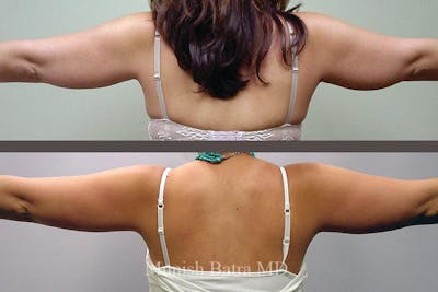 Liposuction & Body Contouring Before & After Gallery - Patient 300308 - Image 1