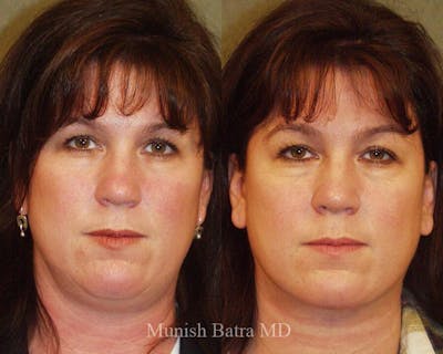 Liposuction & Body Contouring Before & After Gallery - Patient 353604 - Image 1