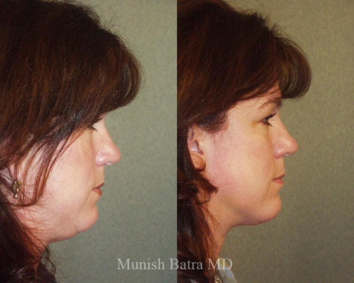 Liposuction & Body Contouring Before & After Gallery - Patient 353604 - Image 2