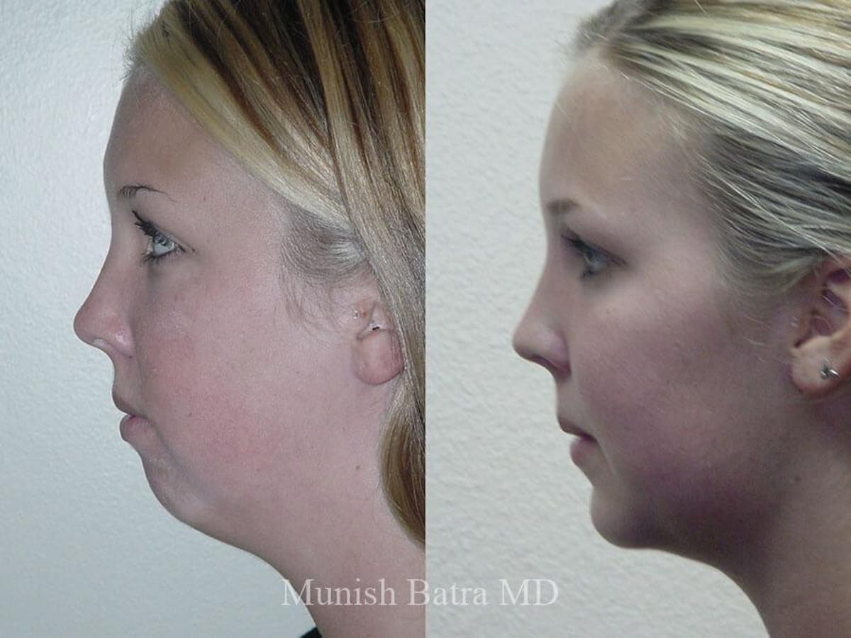 Liposuction & Body Contouring Before & After Gallery - Patient 271302 - Image 1
