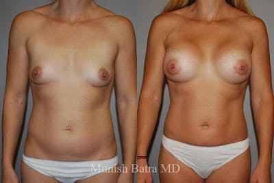 Liposuction & Body Contouring Before & After Gallery - Patient 197149 - Image 1