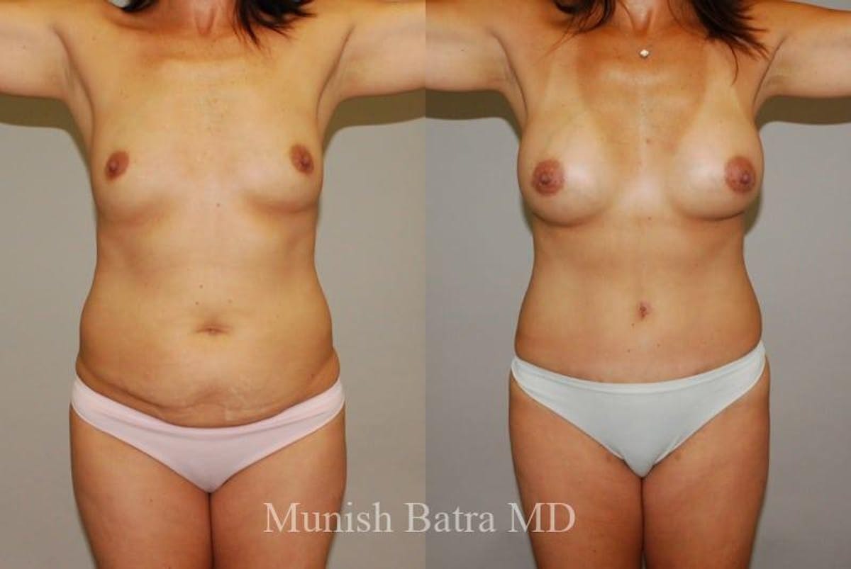 Mommy Makeover Before & After Gallery - Patient 936811 - Image 1