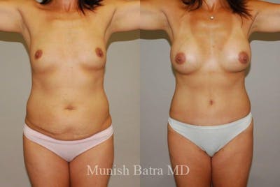 Mommy Makeover Before & After Gallery - Patient 936811 - Image 1