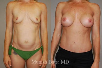 Mommy Makeover Before & After Gallery - Patient 235053 - Image 1