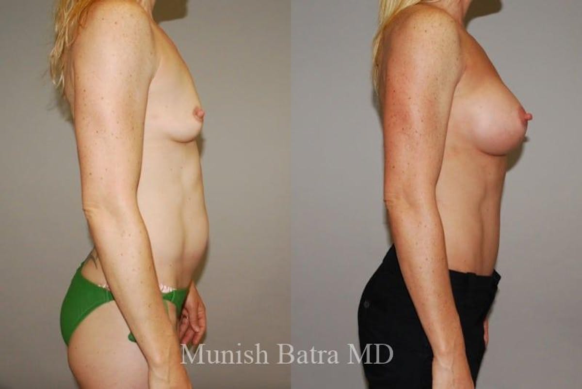 Mommy Makeover Before & After Gallery - Patient 235053 - Image 2