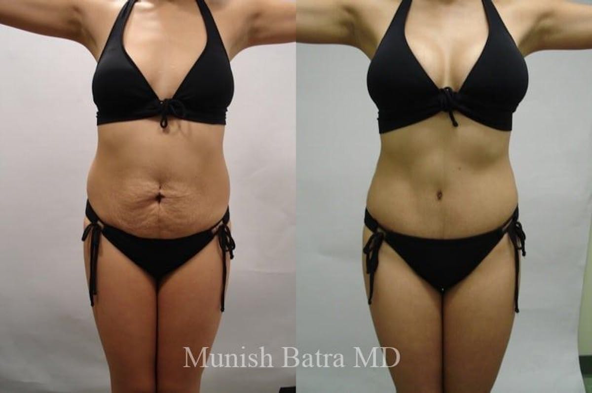 Mommy Makeover Before & After Gallery - Patient 610292 - Image 1