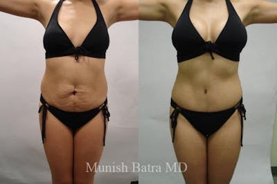 Mommy Makeover Before & After Gallery - Patient 610292 - Image 1