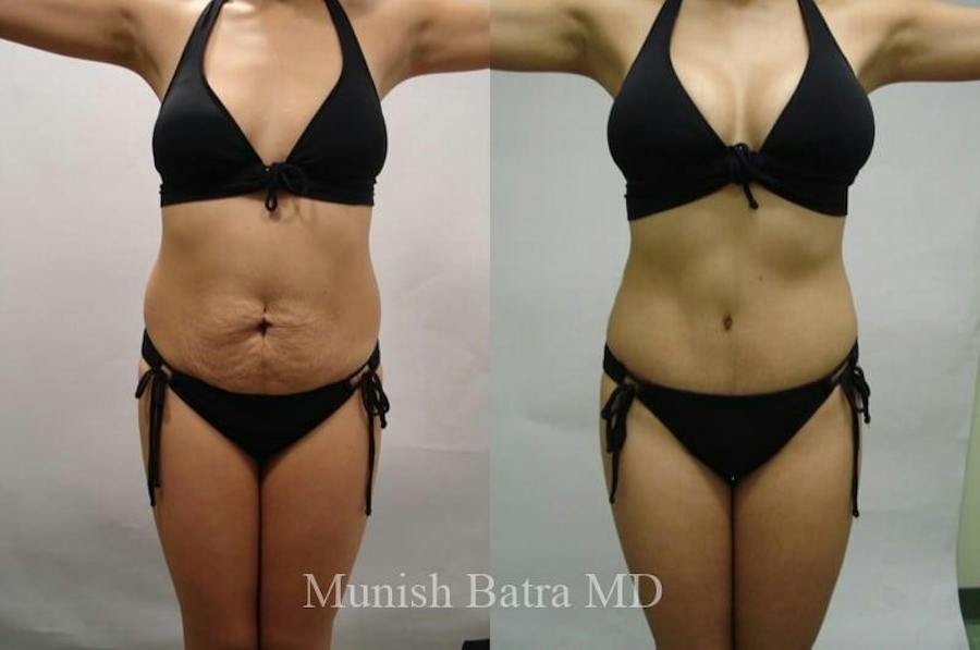 Mommy Makeover patient 610292, front view, before and after