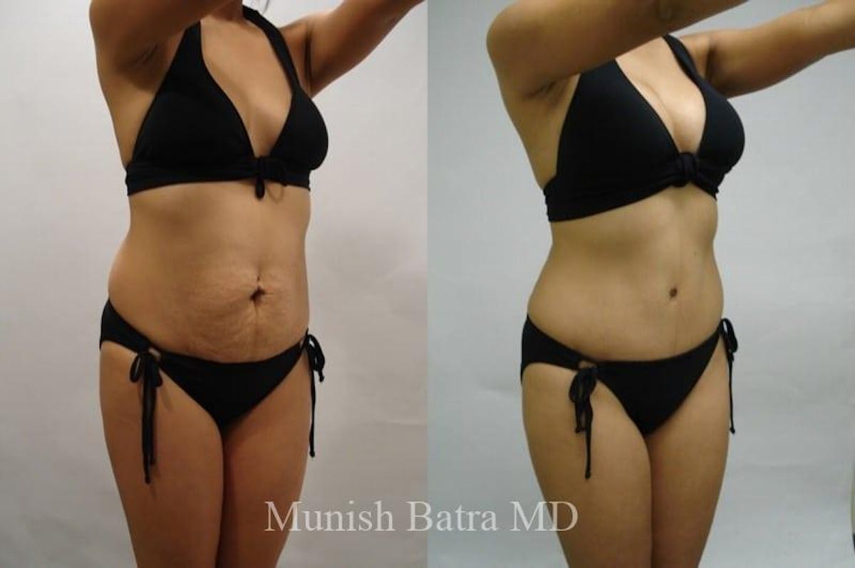 Mommy Makeover Before & After Gallery - Patient 610292 - Image 2