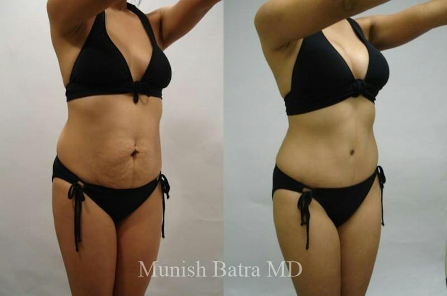 Mommy Makeover patient 610292, side view, before and after
