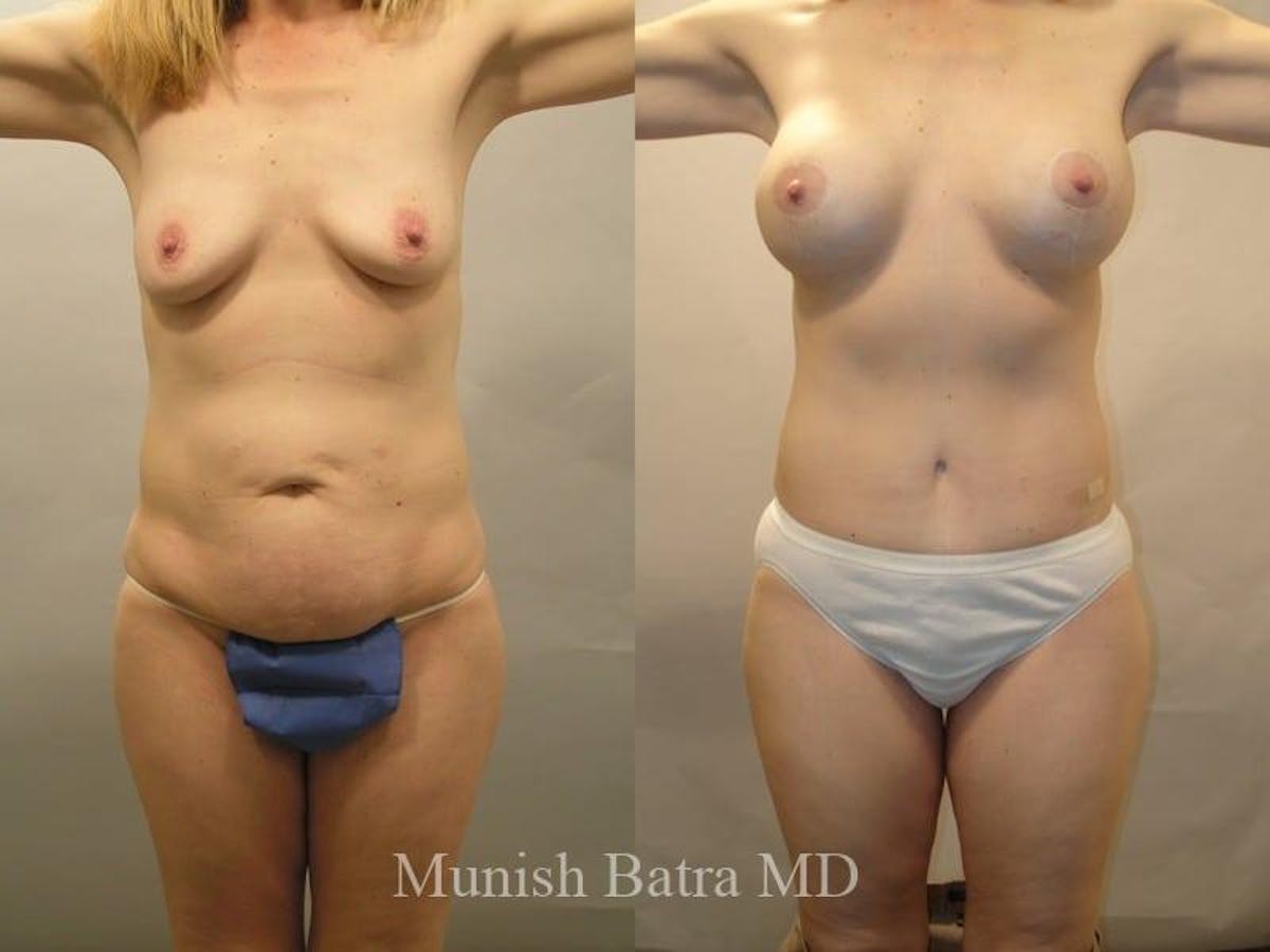 Mommy Makeover Before & After Gallery - Patient 217416 - Image 1