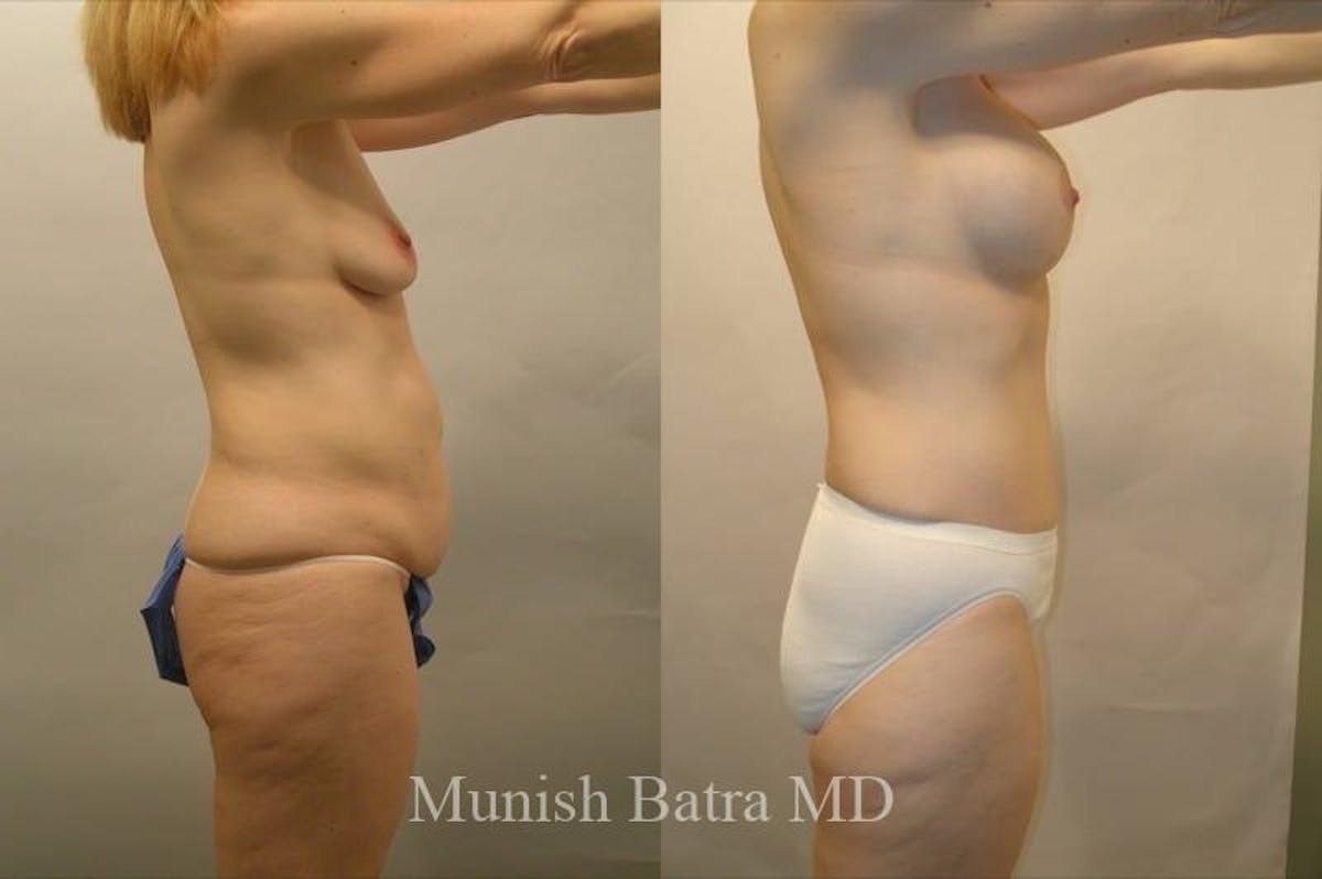 Mommy Makeover Before & After Gallery - Patient 217416 - Image 2