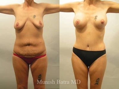 Mommy Makeover Before & After Gallery - Patient 418718 - Image 1
