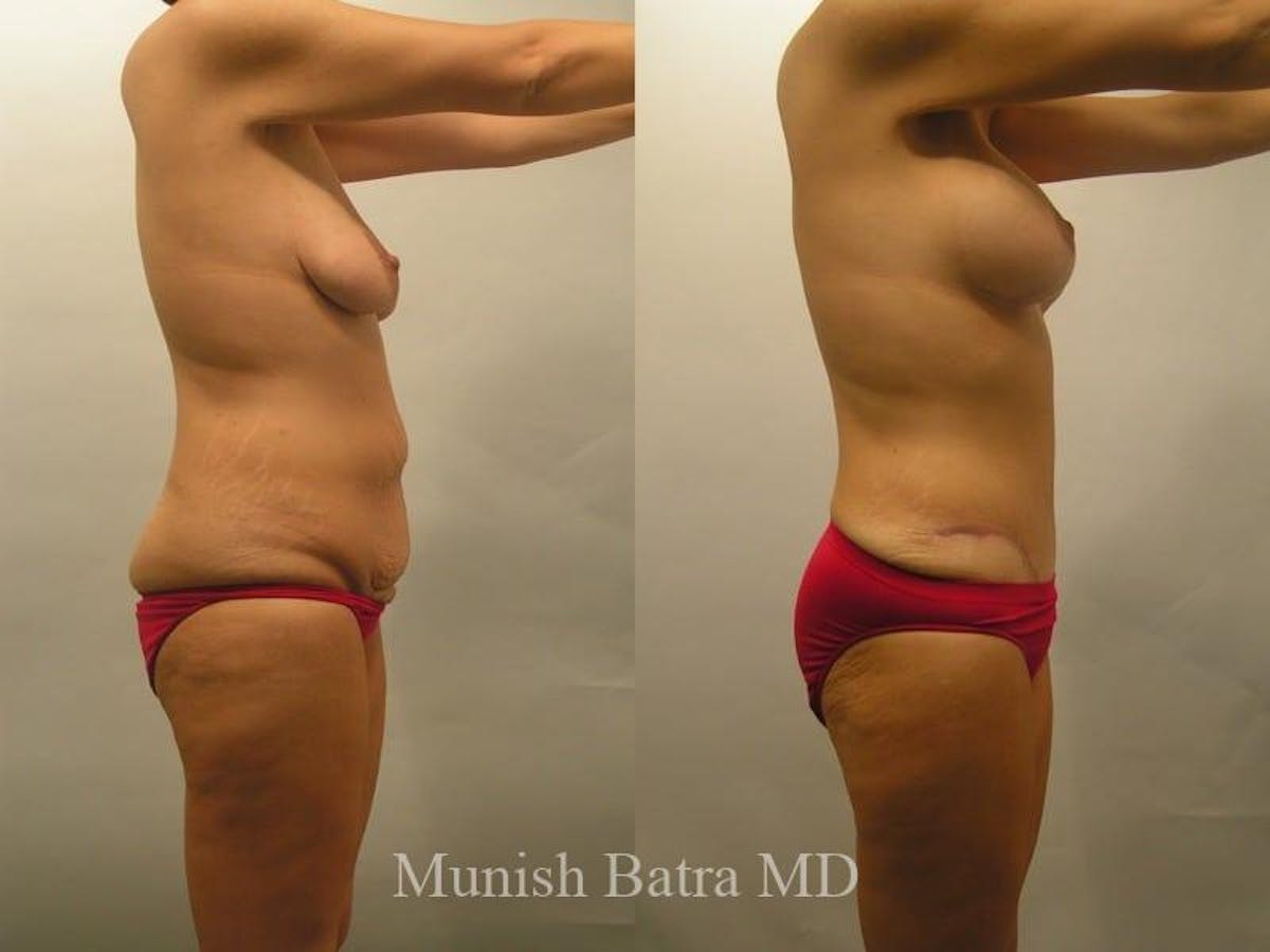 Mommy Makeover Before & After Gallery - Patient 418718 - Image 2