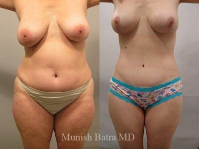 Mommy Makeover Before & After Gallery - Patient 225314 - Image 1