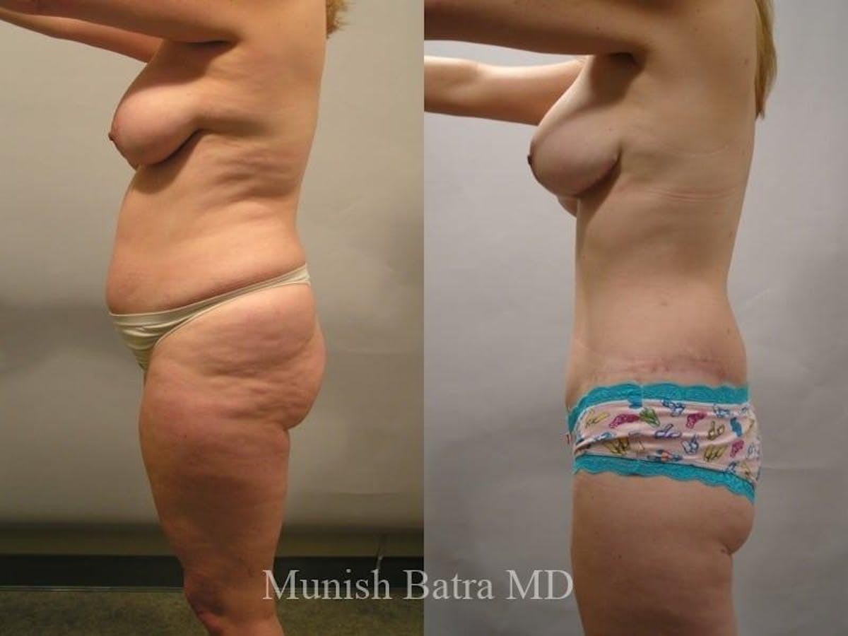 Mommy Makeover Before & After Gallery - Patient 225314 - Image 2