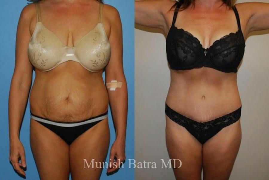 Mommy Makeover patient 393959, front view, before and after