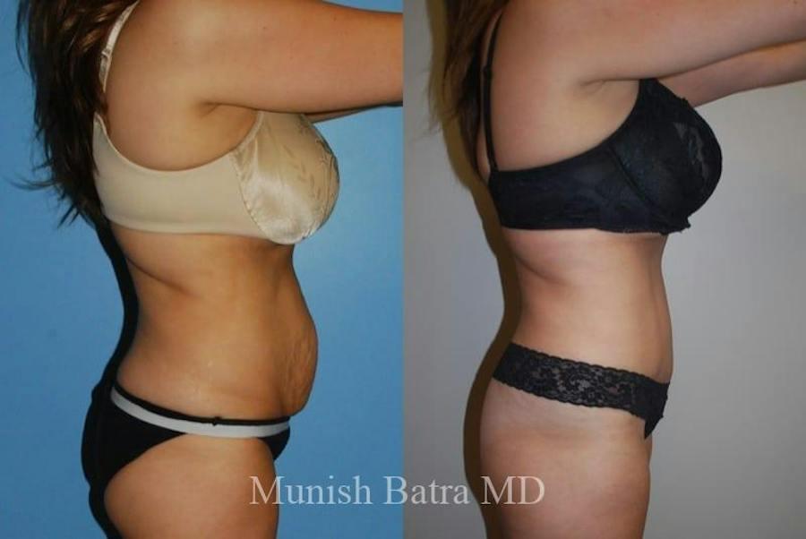 Mommy Makeover patient 393959, side view, before and after