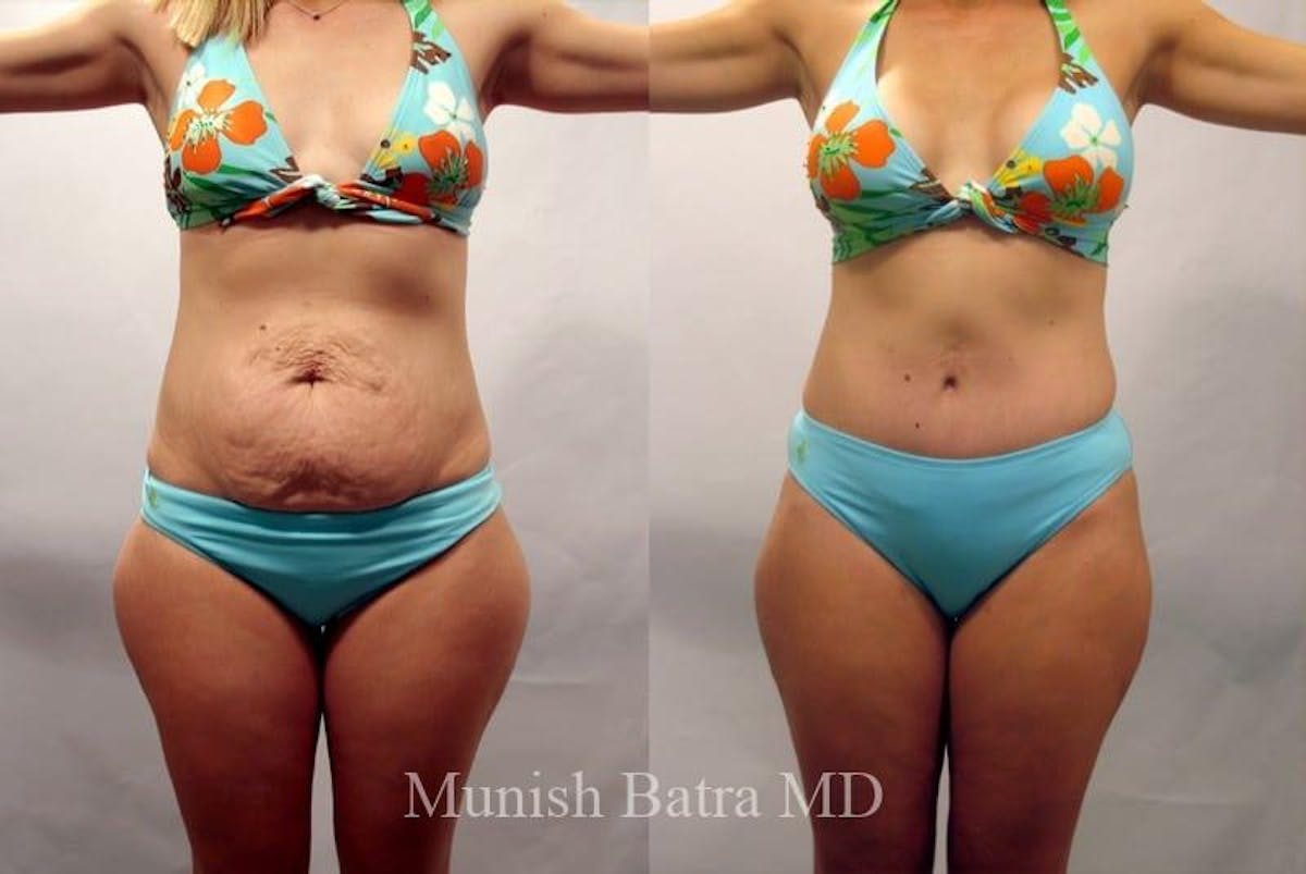 Mommy Makeover Before & After Gallery - Patient 354209 - Image 1