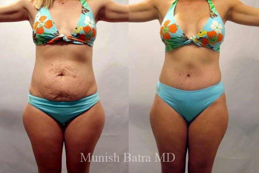 Mommy Makeover patient 354209, front view, before and after