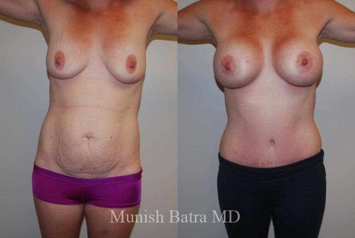 Mommy Makeover Before & After Gallery - Patient 242525 - Image 1