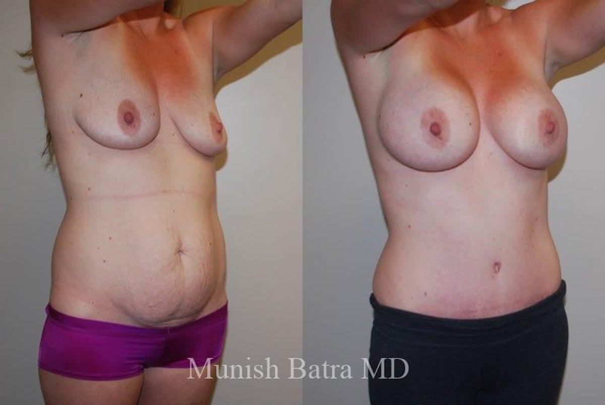 Mommy Makeover Before & After Gallery - Patient 242525 - Image 2