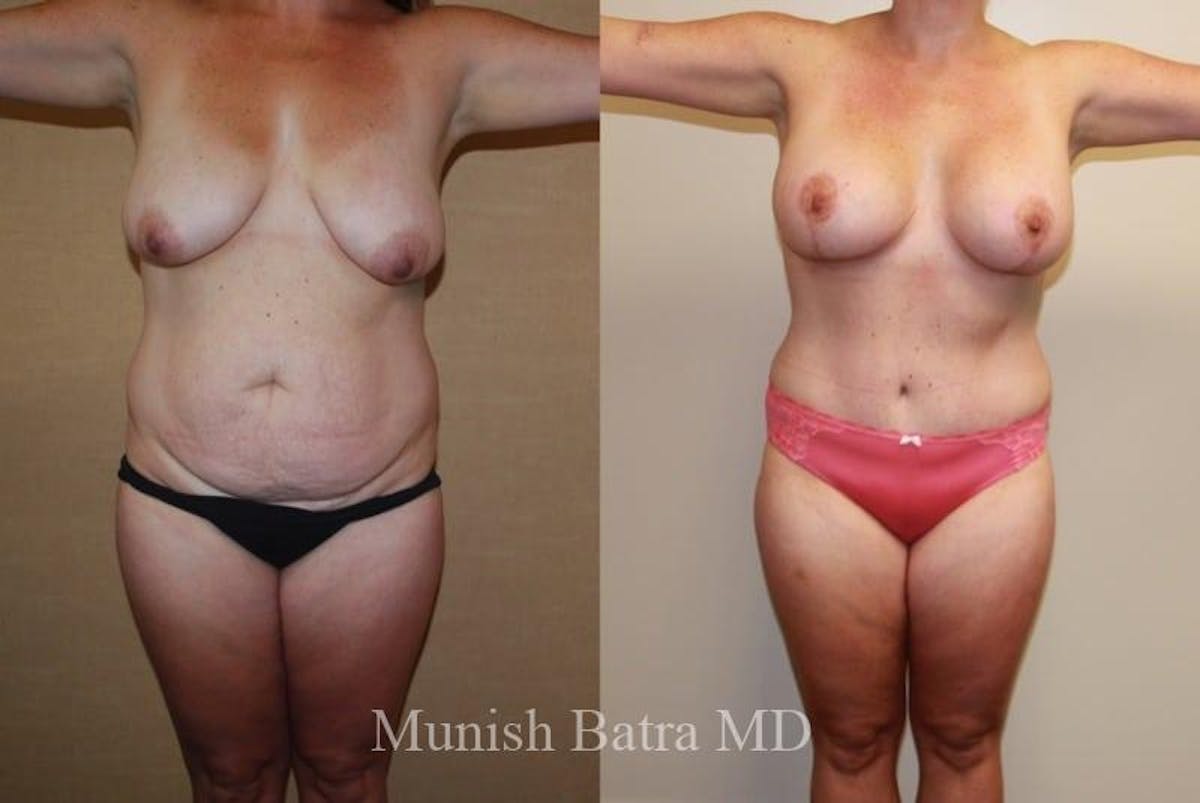 Mommy Makeover Before & After Gallery - Patient 366152 - Image 1