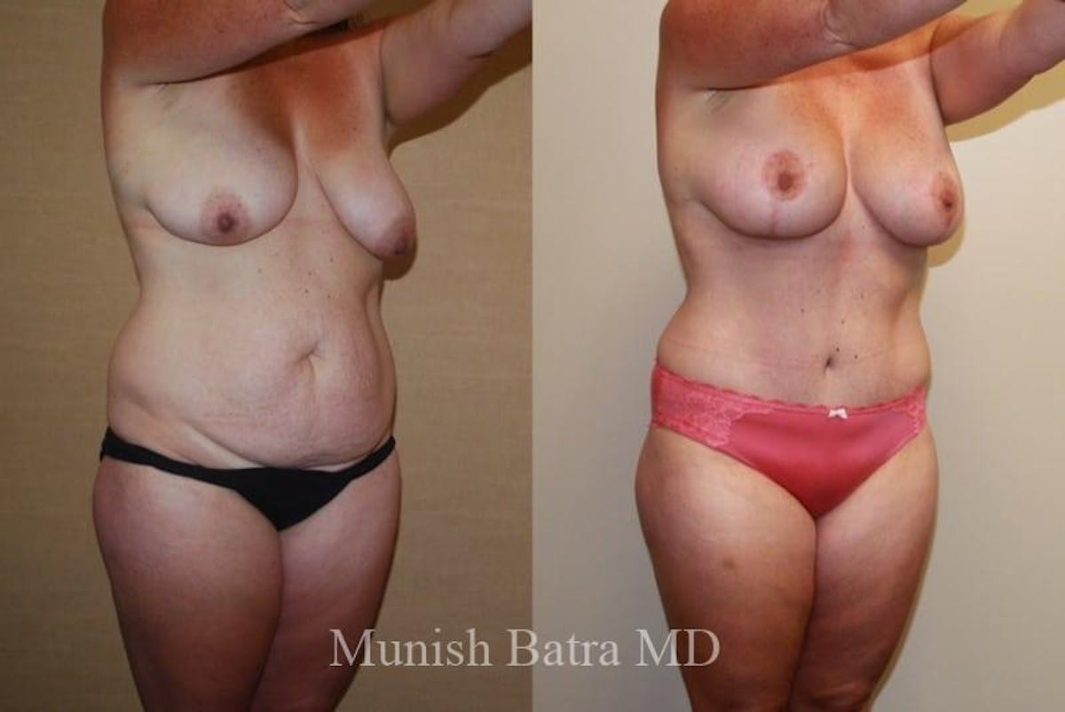 Mommy Makeover Before & After Gallery - Patient 366152 - Image 2