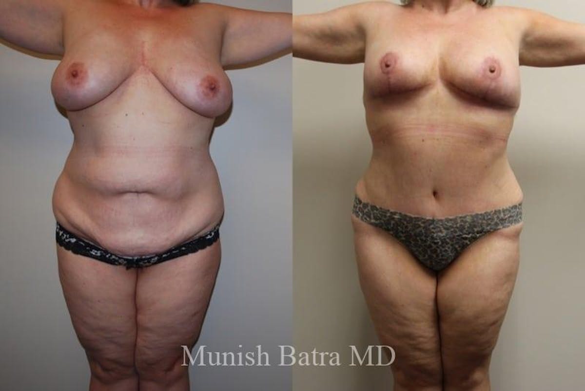 Mommy Makeover Before & After Gallery - Patient 380837 - Image 1