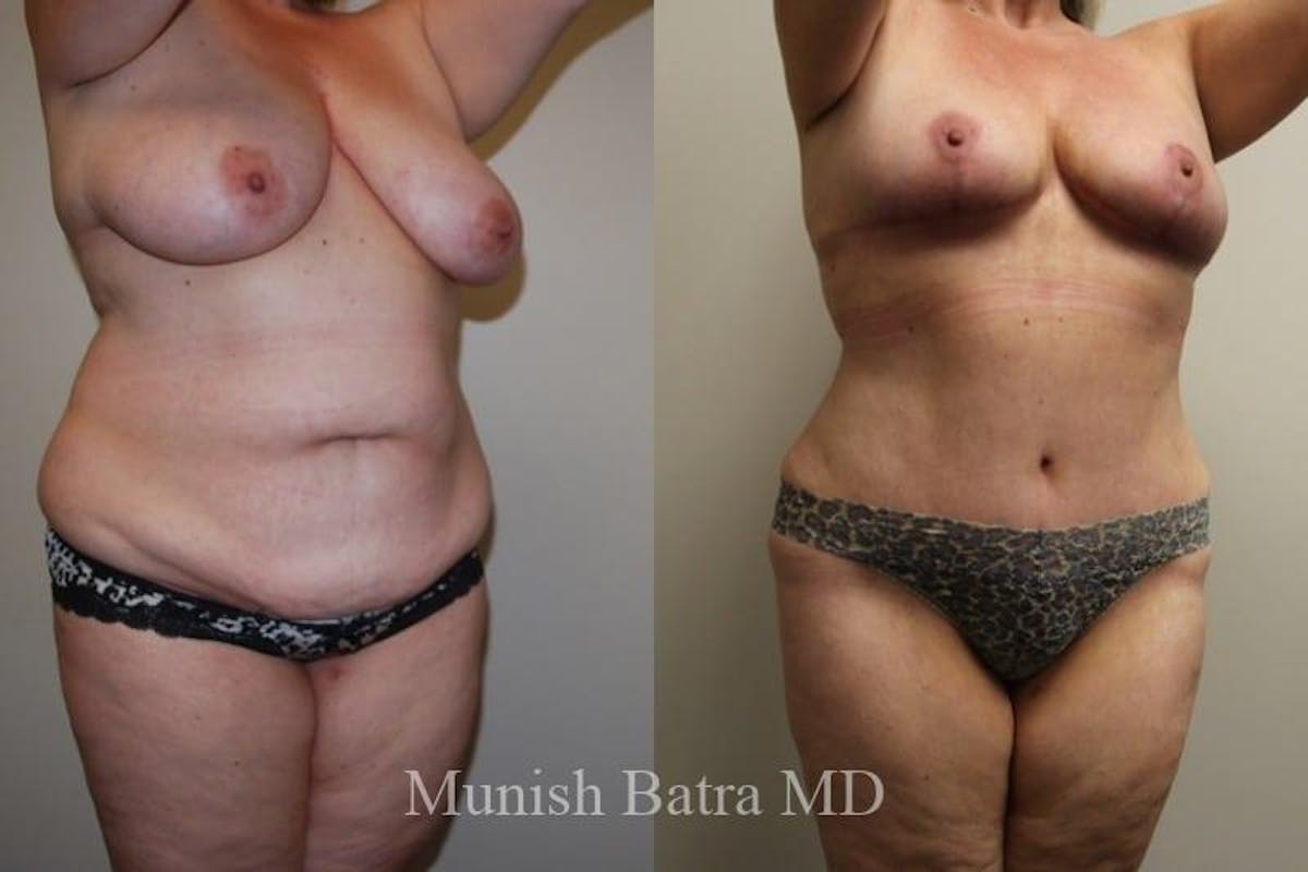 Mommy Makeover Before & After Gallery - Patient 380837 - Image 2