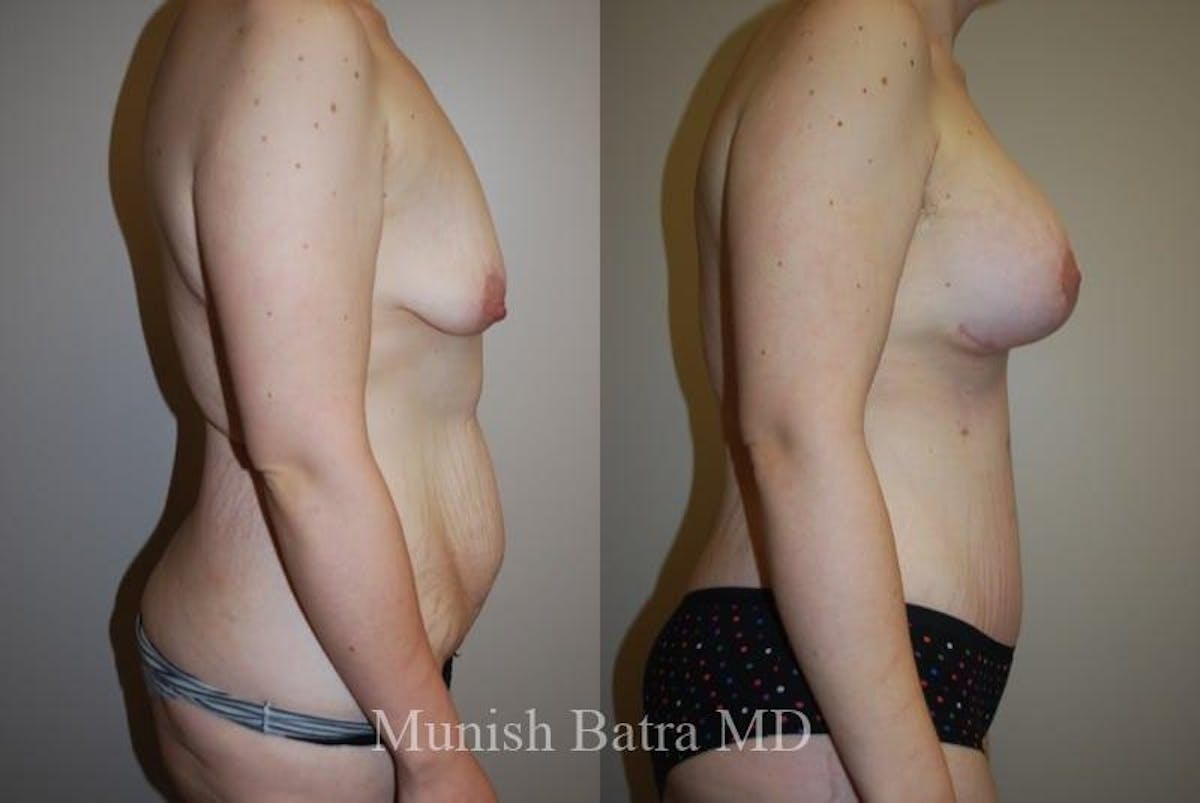 Mommy Makeover Before & After Gallery - Patient 191698 - Image 2