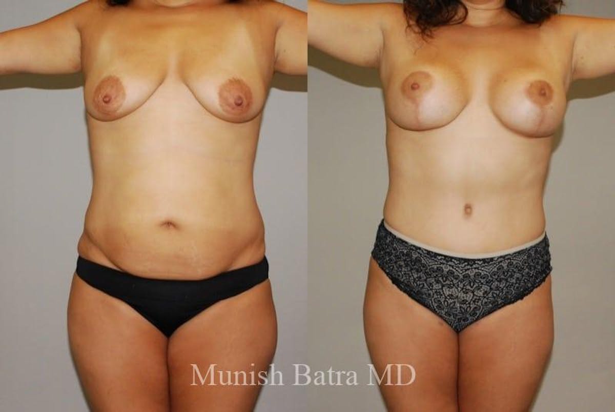 Mommy Makeover Before & After Gallery - Patient 298128 - Image 1