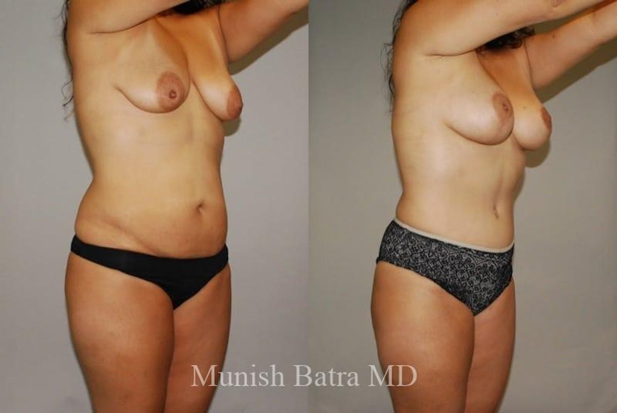 Mommy Makeover Before & After Gallery - Patient 298128 - Image 2