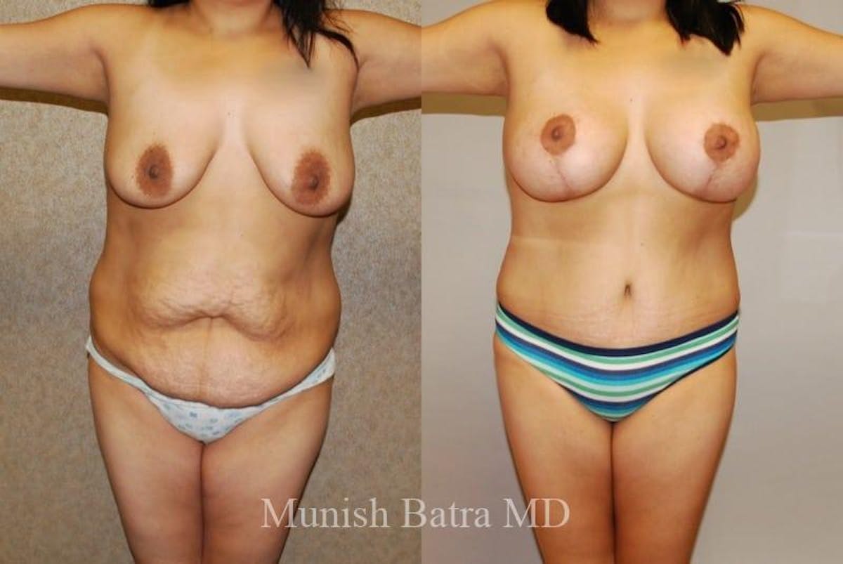 Breast Augmentation with Lift Mastopexy Before & After Gallery - Patient 242880 - Image 1
