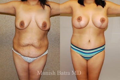 Breast Augmentation with Lift Mastopexy Before & After Gallery - Patient 242880 - Image 1