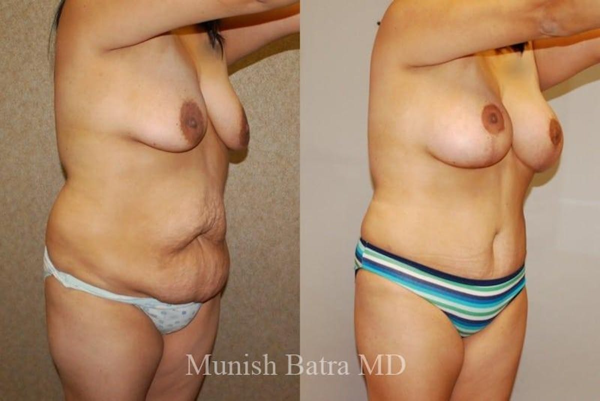 Breast Augmentation with Lift Mastopexy Before & After Gallery - Patient 242880 - Image 2