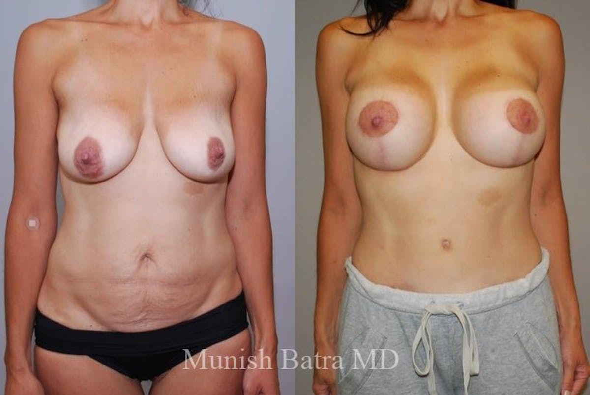 Mommy Makeover Before & After Gallery - Patient 309862 - Image 1