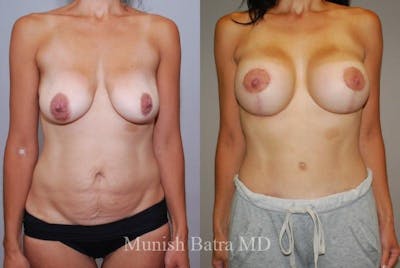 Breast Augmentation with Lift Mastopexy Before & After Gallery - Patient 345883 - Image 1