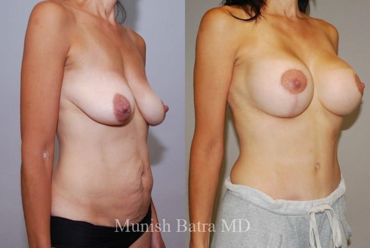 Mommy Makeover Before & After Gallery - Patient 309862 - Image 2