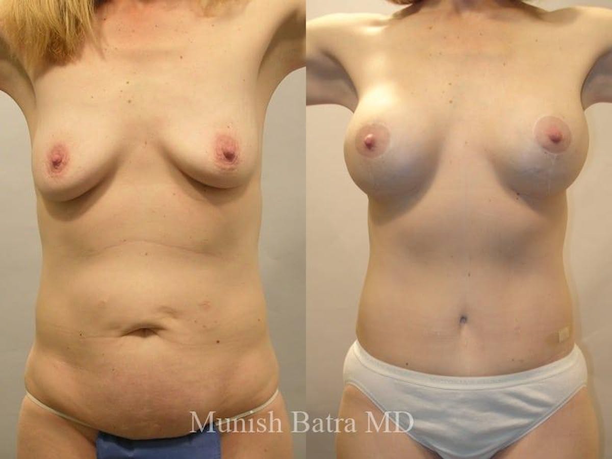 Mommy Makeover Before & After Gallery - Patient 708678 - Image 1